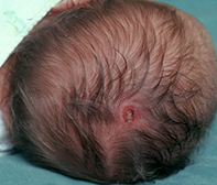 Multiple crusted lesions on the scalp | Medicine Today