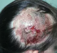 Fig 1. Alopecia
