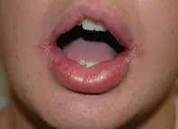Fig. Swollen lips.