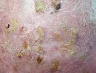 Fig. Scalp lesions