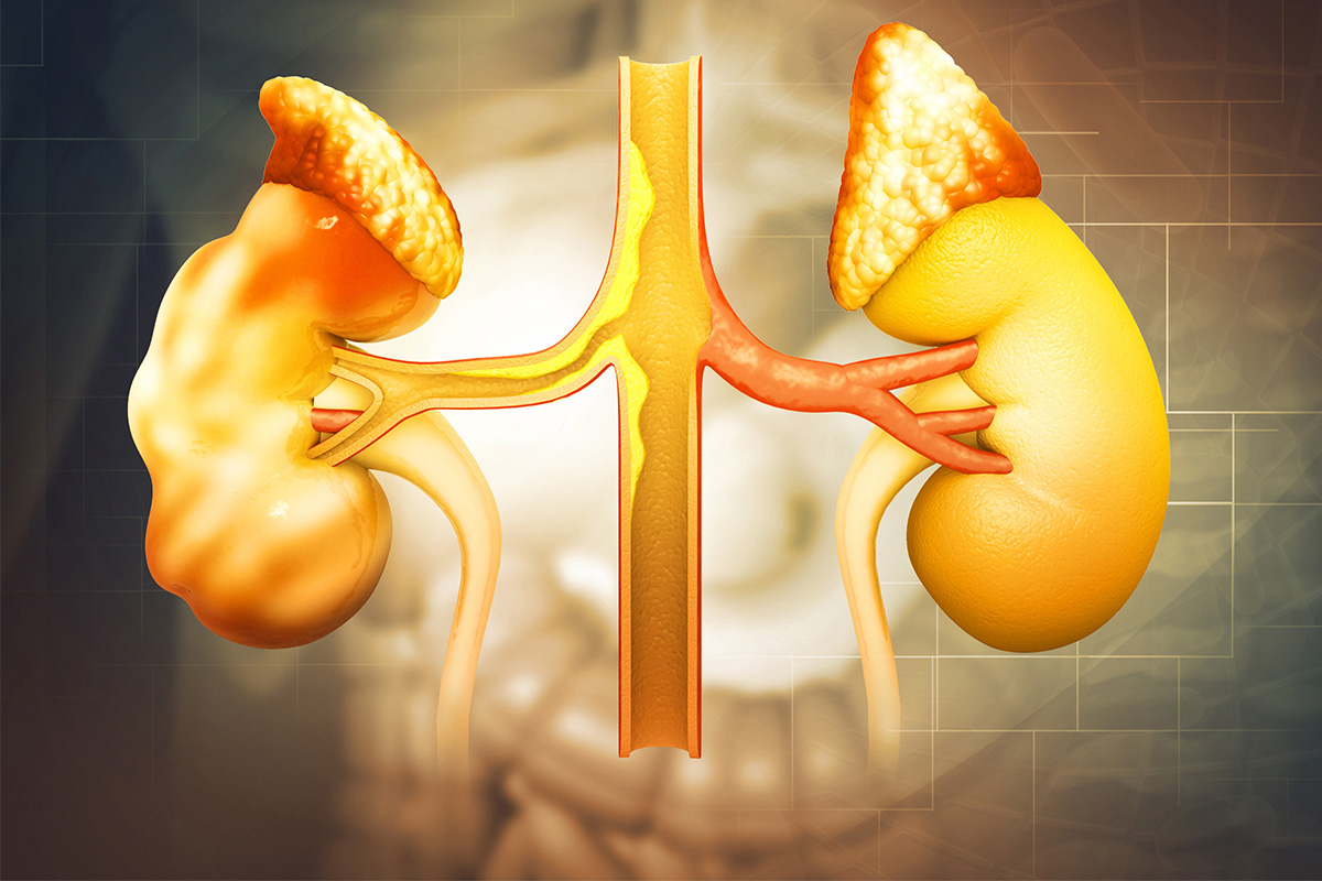 Renal artery stenosis