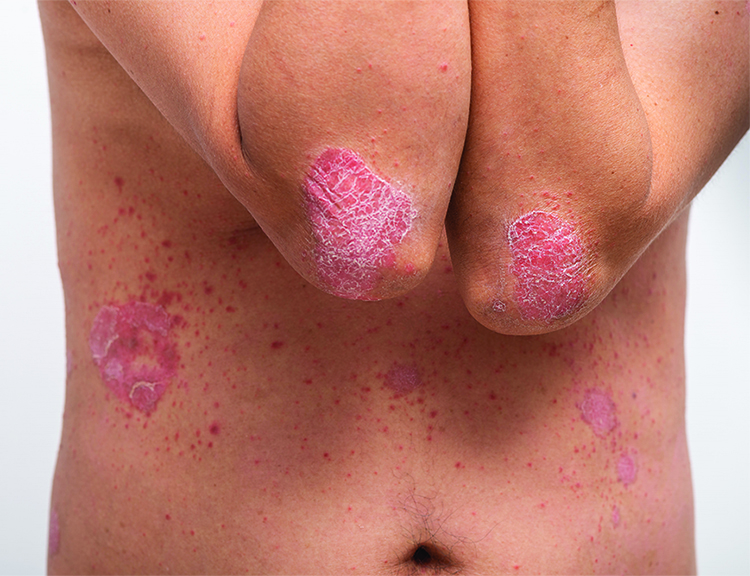 Psoriasis rash