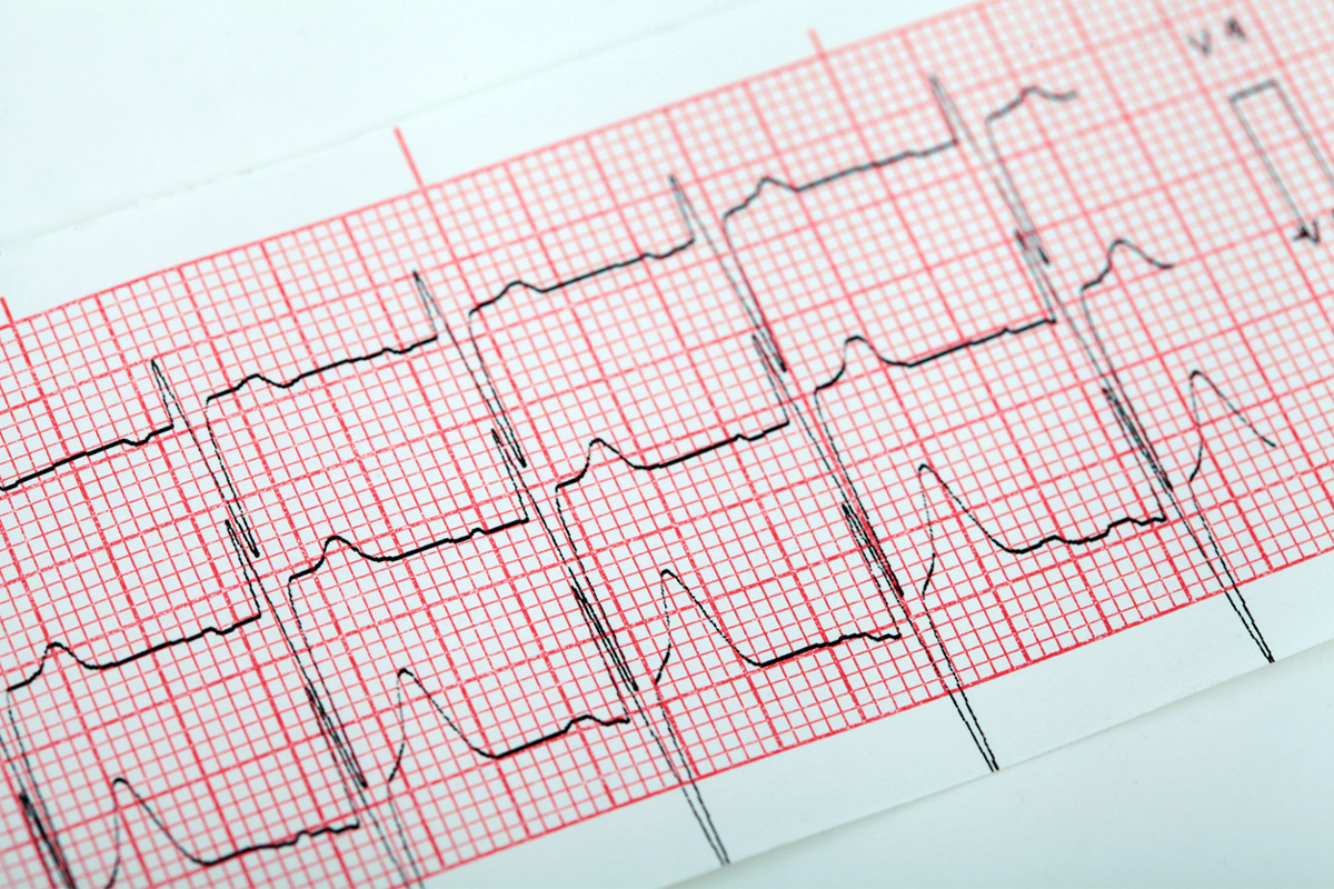 INOCA and MINOCA: coronary vasomotor disorders in clinical practice