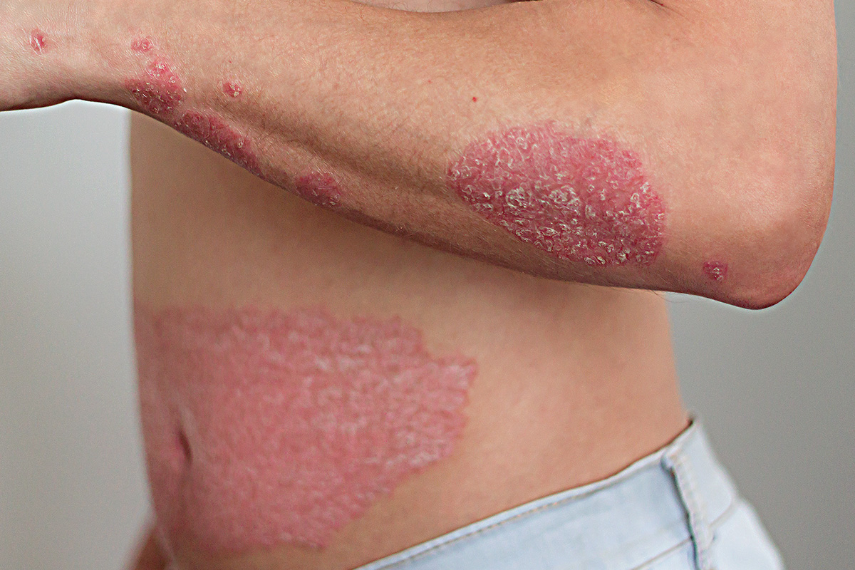 Psoriasis: systemic treatment options for adults