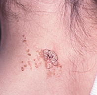 An enlarging lesion on the neck | Medicine Today