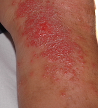 A severe blistering eruption in an elderly patient | Medicine Today