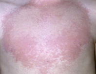 An erythematous and itchy rash in a child | Medicine Today