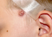 Fig. Facial lesion. Fig. Facial lesion