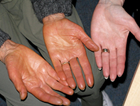 A Woman With Orange Coloured Palms Medicine Today