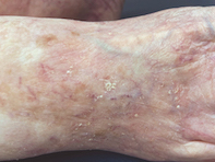 Recurrent scaly papules on sun-exposed skin | Medicine Today