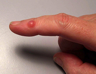 A red nodule the finger | Medicine Today