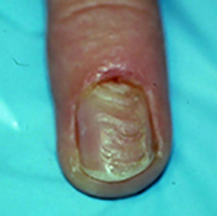 A red nodule on the finger | Medicine Today