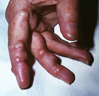 A red nodule the finger | Medicine Today