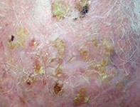 Multiple crusted lesions on the scalp | Medicine Today