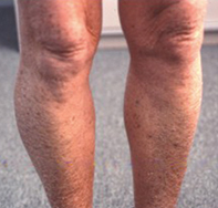 scaly cracked skin on legs