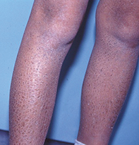 Brown Stains on Legs - Amazing New Treatment – The Whiteley Clinic