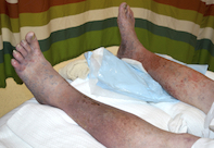Tinea corporis Tinea corporis