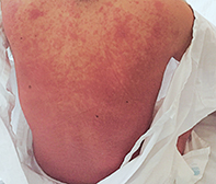 diffuse erythematous rash