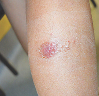 Figure 1b. Lesion on leg.