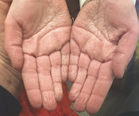 wrinkly skin syndrome