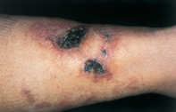 Fig 1. Skin necrosis