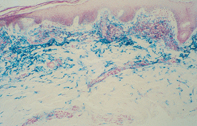 Fig 2. Skin biopsy Fig 2. Skin biopsy