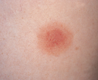 Fig 1. Erythematous lesion
