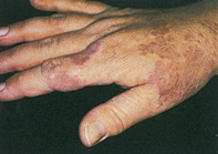 Fig 1. Annular plaques Fig 1. Annular plaques