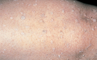 Plaster-like keratoses on the lower limbs | Medicine Today