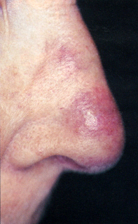 A persistent red nodule on the nose | Medicine Today