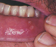 Fig 1. Mouth ulcers