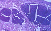 Fig 2. Scrotal biopsy Fig 2. Scrotal biopsy