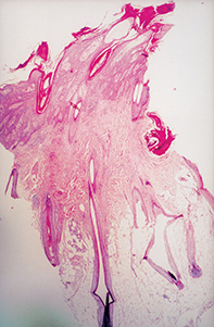 Fig 2. Scalp biopsy Fig 2. Scalp biopsy