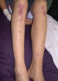 vascular rash