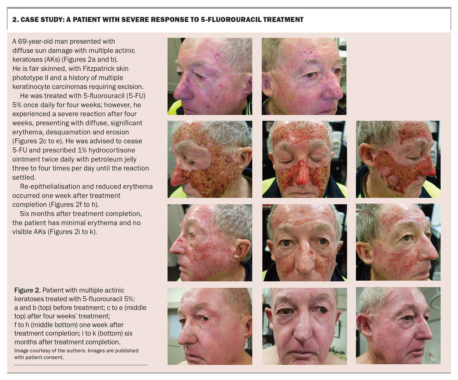 Fluorouracil Cream