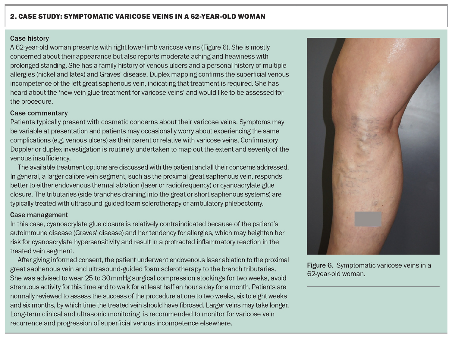 Varicose veins – more than a cosmetic concern