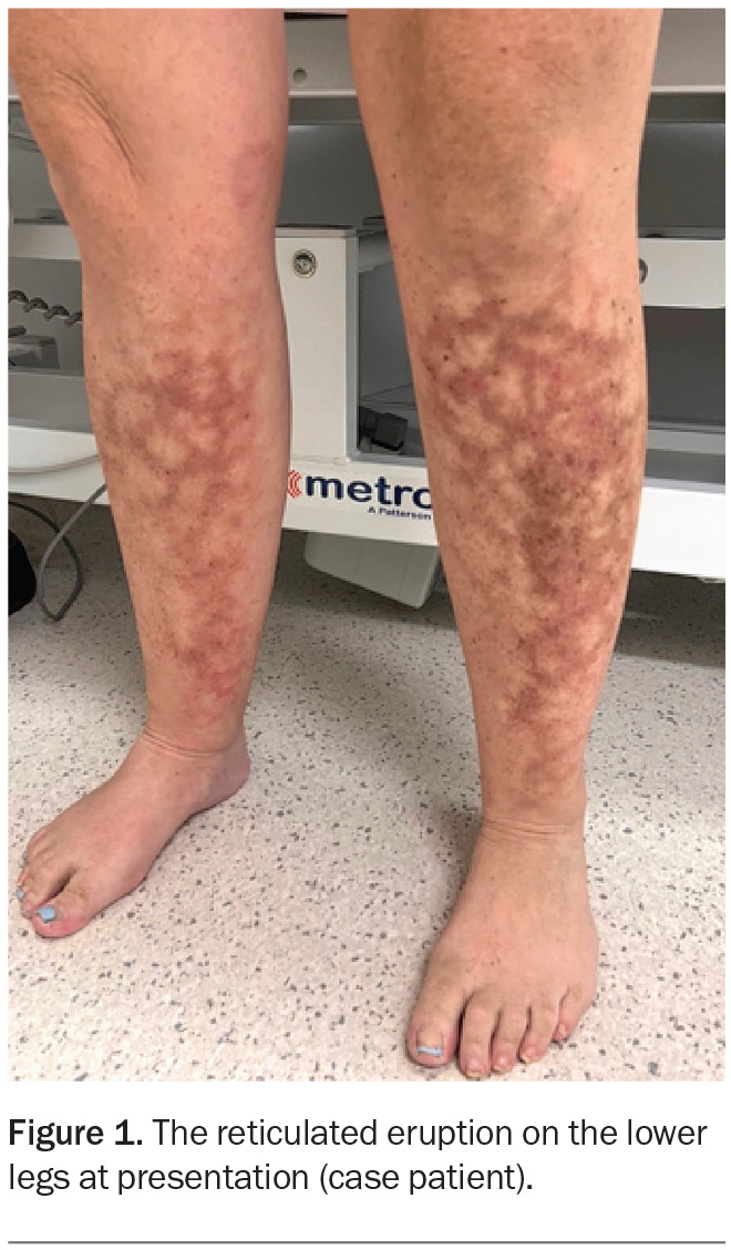 Reticulated Hyperpigmentation And Erythema On The Legs Medicine Today