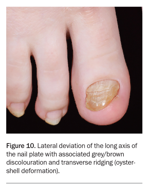 Dermatology: Nails Flashcards | Quizlet