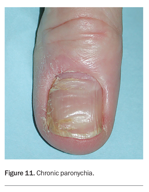 Onychomycosis or fungal nail infection on damaged nails after gel polish,  onychosis. Longitudinal ridging nails with psoriasis, nail diseases. Health  Stock Photo - Alamy
