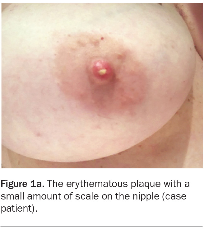Psoriasis on Nipple and Areola: Pictures, Signs, Relief