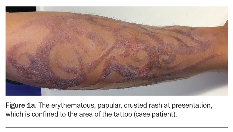 Allergies | Free Full-Text | A Peculiar Case of Allergic Granulomatous  Reaction to Red Pigment: A Tattoo Touch-Up Treated Surgically