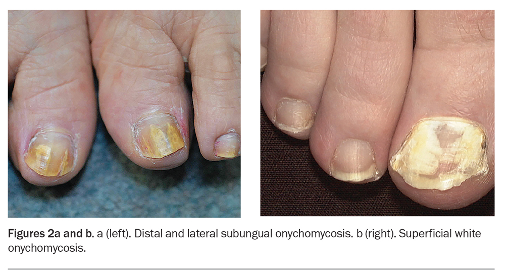 Nail Disorders Clinic  Dermatology  OHSU