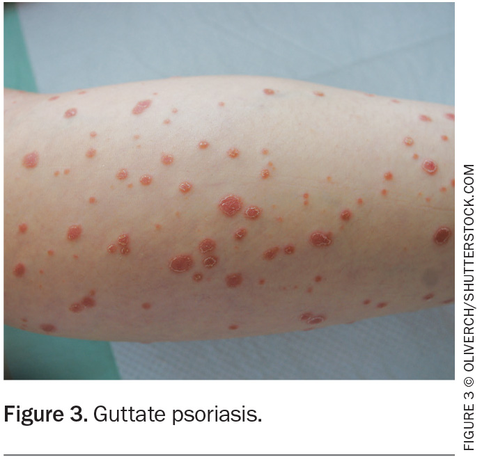 Psoriasis In Children Symptoms Types How To Deal With It 46 Off
