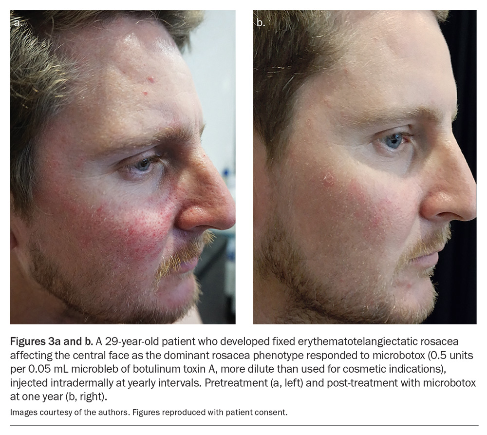 glutathione rosacea Rosacea