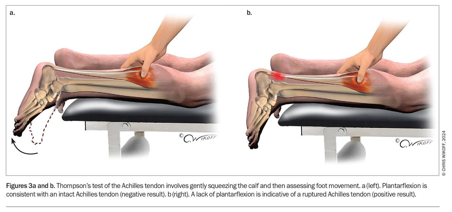 Achilles Tendinitis Ruptured Achilles Pain Bilateral Achilles Tendon