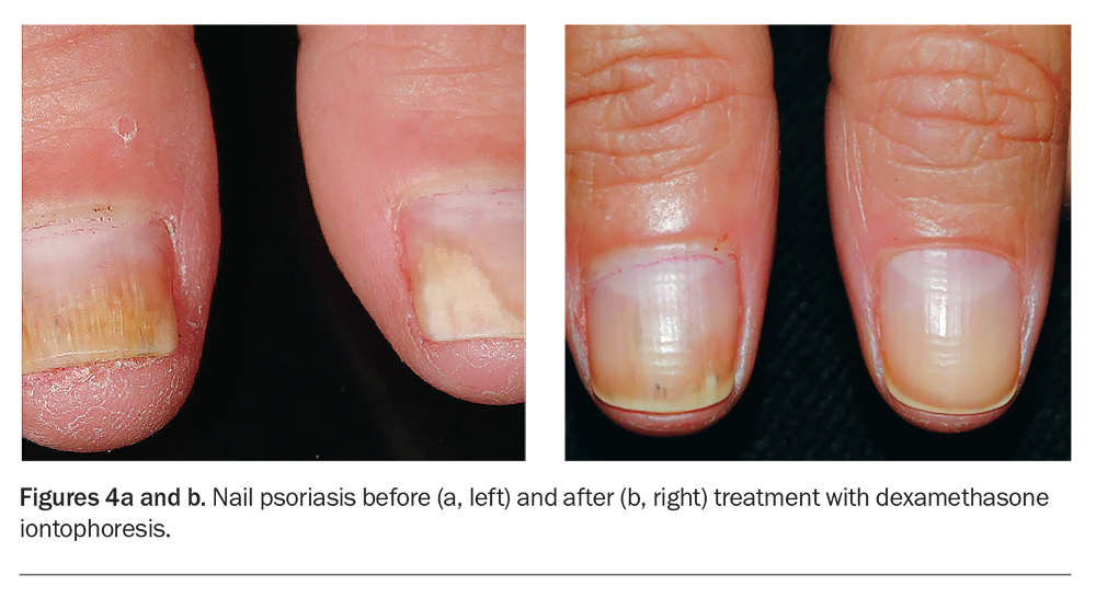 How to tell the difference between nail psoriasis and fungus | Optum Perks