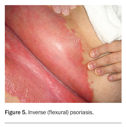 PDF] Tinea manuum misdiagnosed as psoriasis vulgaris: A case of
