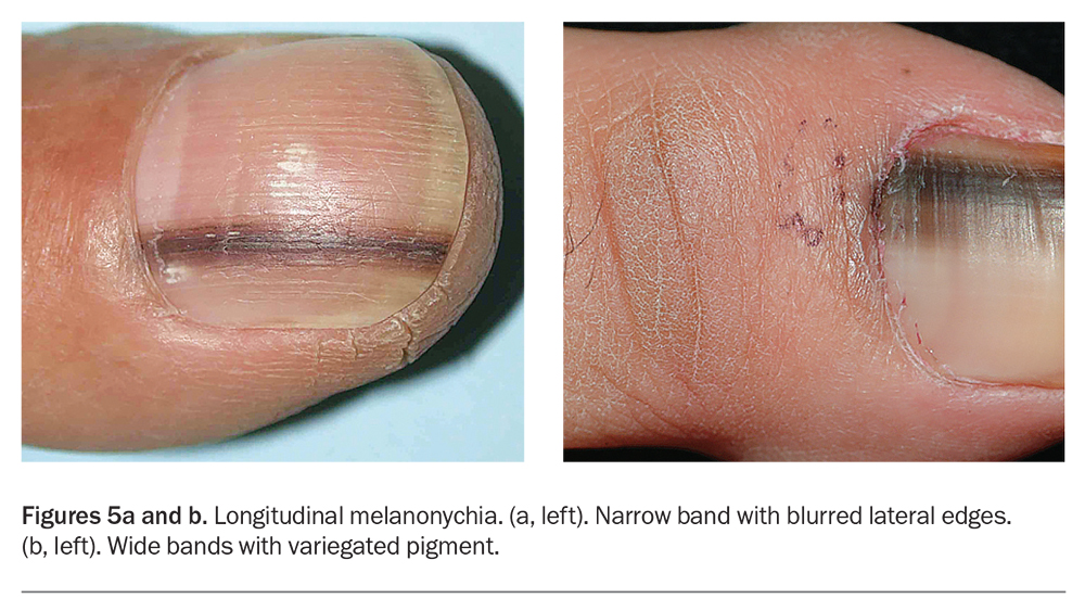 Conditions that frequently affect a single nail | Plastic Surgery Key