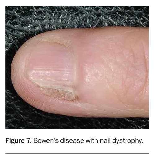 Nail Disease and Disorders