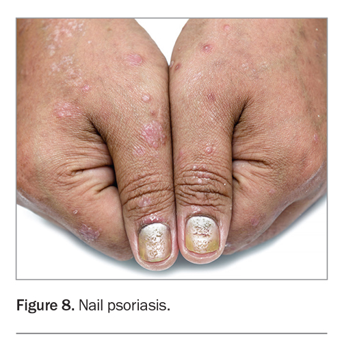 Mild nail psoriasis : r/PsoriaticArthritis